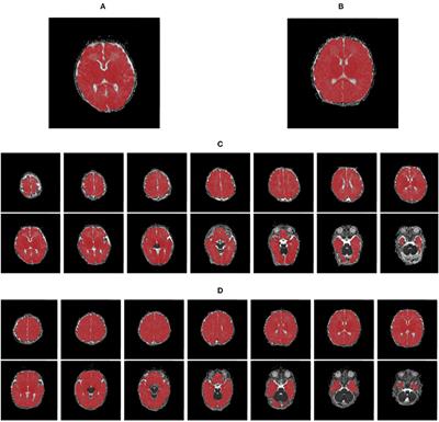 Multi-Slice Radiomic Analysis of Apparent Diffusion Coefficient Metrics Improves Evaluation of Brain Alterations in Neonates With Congenital Heart Diseases